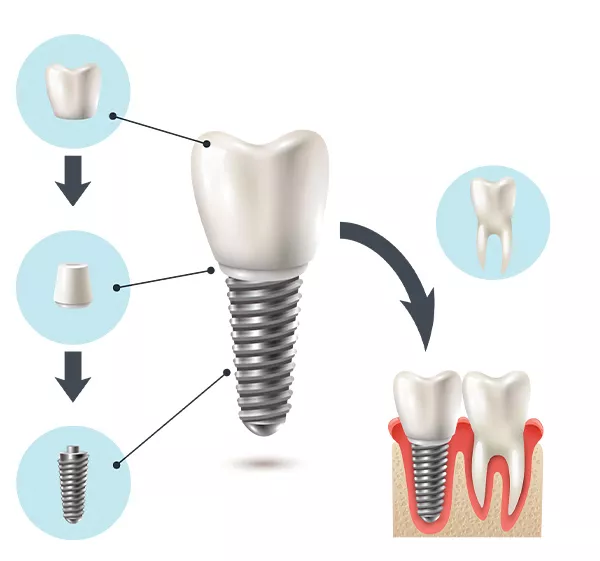 Zubní implantát